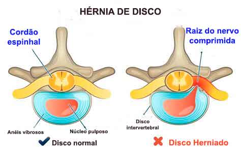 A Efic Cia E Seguran A No Tratamento H Rnia De Disco Sem O Uso De Cirurgias Dr Carlos Lopes